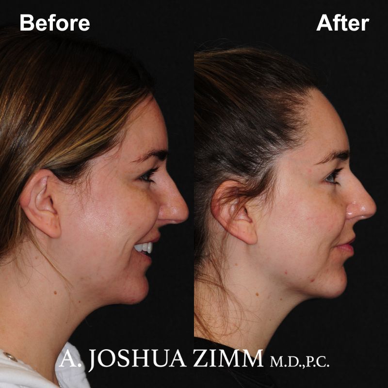 8 Chin Implant Before And After
