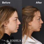 8 Revision Rhinoplasty 1