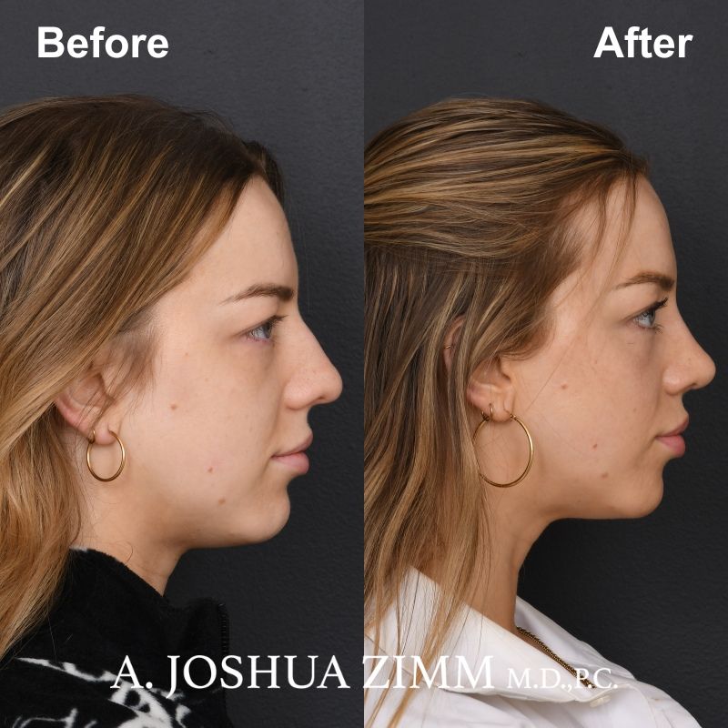 8 Revision Rhinoplasty 1