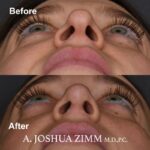 8 Revision Rhinoplasty 3