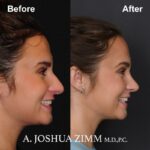 8 Rhinoplasty Before And After 1