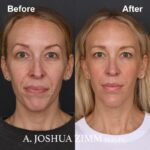8 Rhinoplasty Before And After 10
