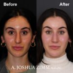 8 Rhinoplasty Before And After 11
