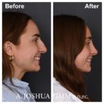 8 Rhinoplasty Before And After 12