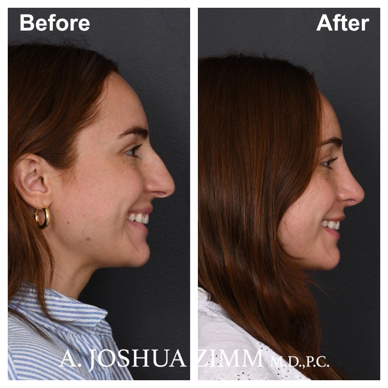 8 Rhinoplasty Before And After 12