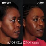 8 Rhinoplasty Before And After 13