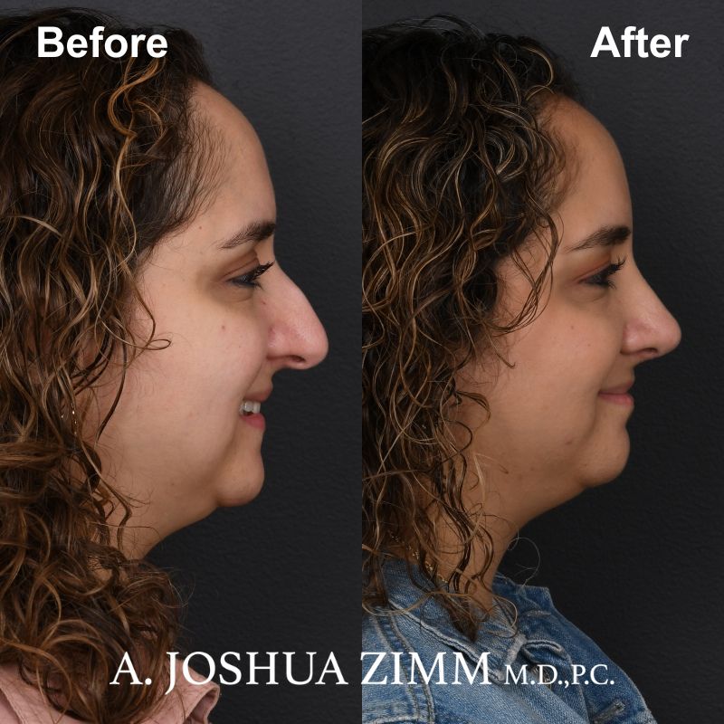 8 Rhinoplasty Before And After 14