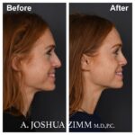 8 Rhinoplasty Before And After 16