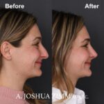 8 Rhinoplasty Before And After 17
