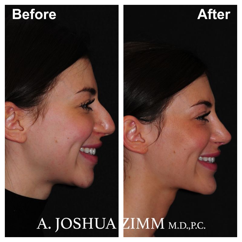 8 Rhinoplasty Before And After 18