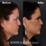 8 Rhinoplasty Before And After 2