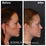 8 Rhinoplasty Before And After 20