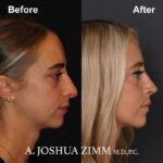 8 Rhinoplasty Before And After 21