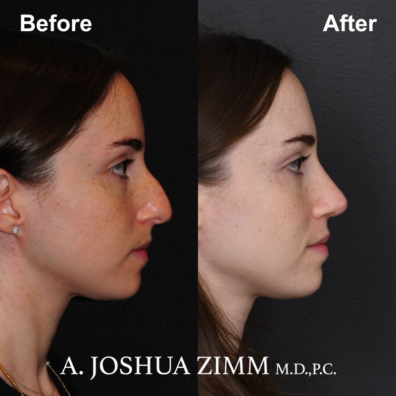 8 Rhinoplasty Before And After 22
