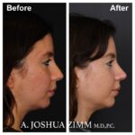 8 Rhinoplasty Before And After 25