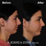 8 Rhinoplasty Before And After 26