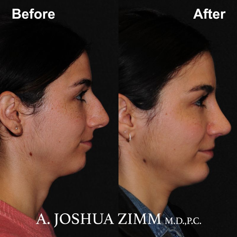 8 Rhinoplasty Before And After 26