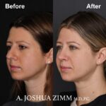 8 Rhinoplasty Before And After 28