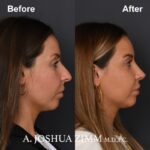 8 Rhinoplasty Before And After 29