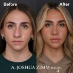 8 Rhinoplasty Before And After 3