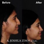 8 Rhinoplasty Before And After 31