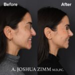 8 Rhinoplasty Before And After 34