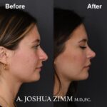 8 Rhinoplasty Before And After 35