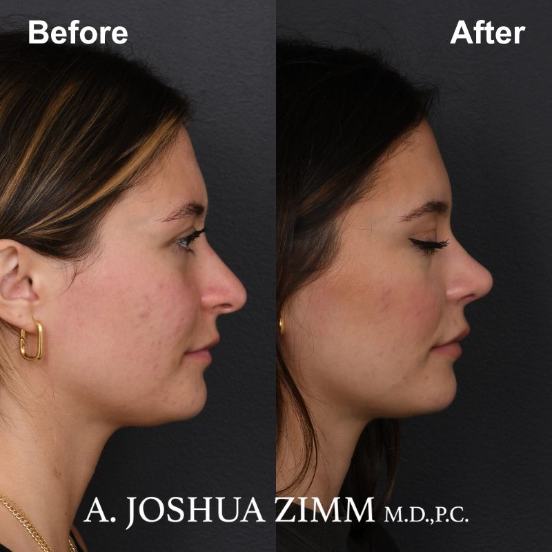 8 Rhinoplasty Before And After 35