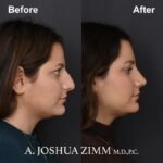 8 Rhinoplasty Before And After 36