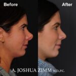 8 Rhinoplasty Before And After 37