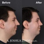 8 Rhinoplasty Before And After 38