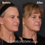 8 Rhinoplasty Before And After 39