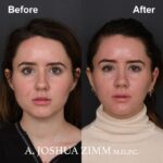 8 Rhinoplasty Before And After 40