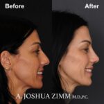8 Rhinoplasty Before And After 42