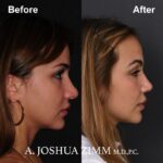 8 Rhinoplasty Before And After 44