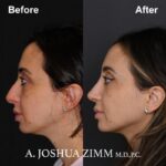8 Rhinoplasty Before And After 45