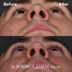 8 Rhinoplasty Before And After 46