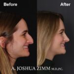 8 Rhinoplasty Before And After 47 1