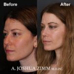 8 Rhinoplasty Before And After 48