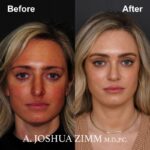 8 Rhinoplasty Before And After 49