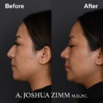 8 Rhinoplasty Before And After 5