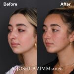 8 Rhinoplasty Before And After 50