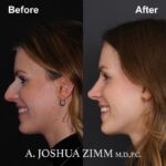 8 Rhinoplasty Before And After 6