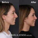 8 Rhinoplasty Before And After 7