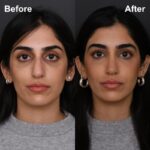 8mo Post OSR FPNS