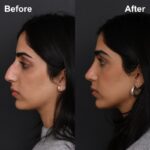 8mo Post OSR LPNS