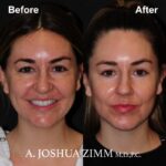 9 Chin Implant Before And After