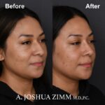 9 Rhinoplasty Before And After 1