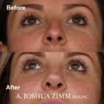 9 Rhinoplasty Before And After 10