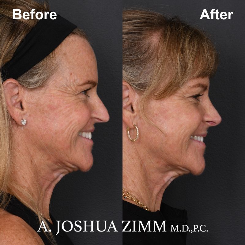 9 Rhinoplasty Before And After 14